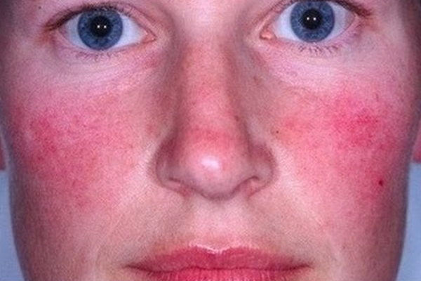 miért vörös az arcom magas vérnyomás kezelése fiatal férfiaknál