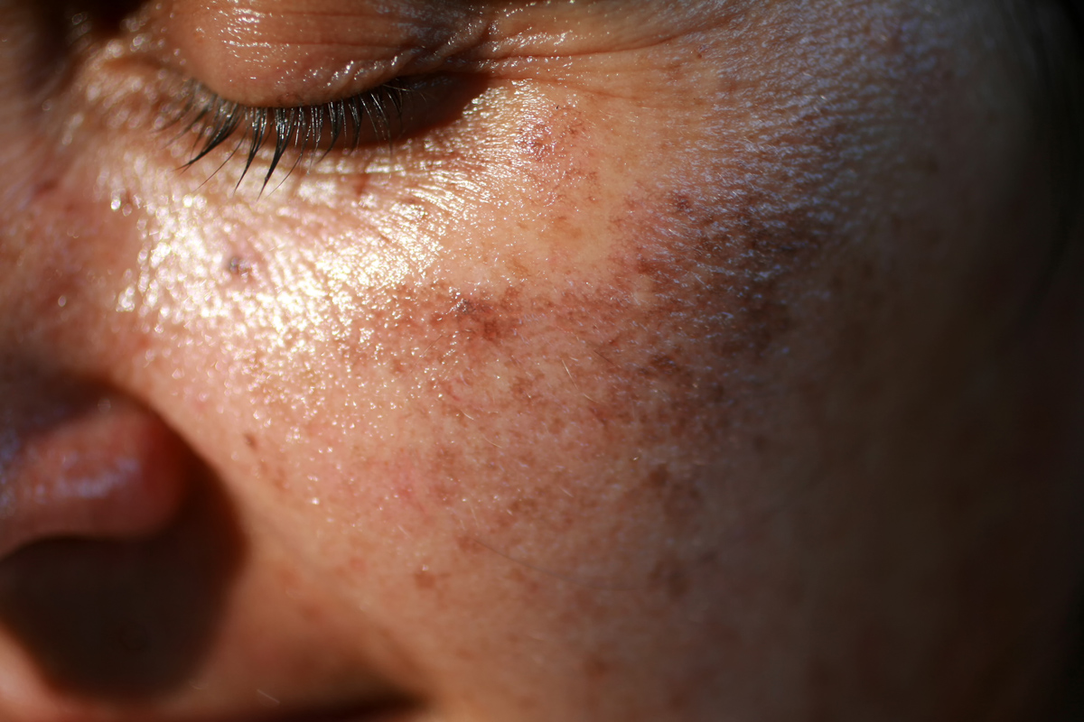 hatékony orvosság az arcon lévő vörös foltok ellen újdonság gyógyszerek pikkelysömörhöz