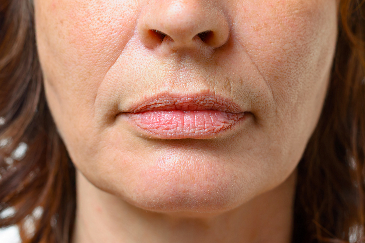 száj körüli ráncok ránctalanító krém problémás bőrre